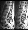 Mri of lumbar spine in sagittal plane Royalty Free Stock Photo