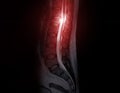 MRI Lumbar spine sagittal T2W Fat suppression Royalty Free Stock Photo