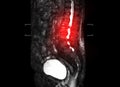 MRI Lumbar spine sagittal T2W Fat suppression Royalty Free Stock Photo