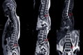 MRI of lumbar spine showing Cervical spondylosis with mild to moderate spinal cord compression at C4-5 and C5-6 with myelopathy