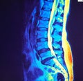 Mri of lumbar spine stenosis Royalty Free Stock Photo