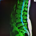 Mri of lumbar spine stenosis Royalty Free Stock Photo