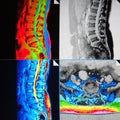 Mri of lumbar spine stenosis Royalty Free Stock Photo