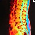 Mri of lumbar spine stenosis Royalty Free Stock Photo