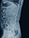 MRI of lumbar spine the study reveals burst fracture of L2 vertebral body