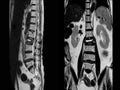 MRI of lumbar spine the study reveals burst fracture of L2 vertebral body