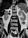 MRI of lumbar spine the study reveals burst fracture of L2 vertebral body