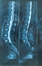 MRI Lumbar spine Royalty Free Stock Photo