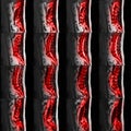 MRI Of Lumbar And Thoracic Vertebral Column Showing Spinal Disc Herniation