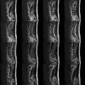 MRI Of Lumbar And Thoracic Vertebral Column