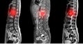 MRI OF THE LUMBOSACRAL SPINE A female with low back pain for 3 months, to rule out HNP or TB spine