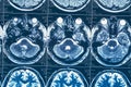 MRI or magnetic resonance image of head and brain scan Royalty Free Stock Photo