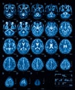 MRI (Magnetic resonance imaging) of the brain, transvers view, T2.