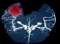 MRA brain or Magnetic resonance angiography image MRA of cerebral artery in the hemorrhage in brain