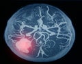 MRA brain or Magnetic resonance angiography image MRA of cerebral artery in the hemorrhage in brain