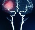 MRA brain or Magnetic resonance angiography image MRA of cerebral artery in the hemorrhage in brain