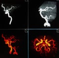 Mri of neck and brain vessels