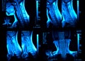 MRI neck scan Royalty Free Stock Photo