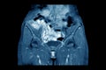 MRI Pelvic of a Healthy Woman finding Abnormalities like mass lumps.Medical healthcare concept Royalty Free Stock Photo