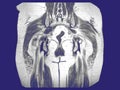 MRI OF THE PELVIS There is ill-defined marrow infiltrative lesion involving nearly the entire left femoral head