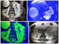 Mri polycystic kidney numerous hepatic cysts