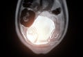 MRI during pregnancy ensures non-invasive evaluation of fetal health, maternal safety, obstetric care, and diagnostic precision,