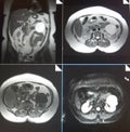 Mri of renal cyst