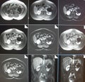 Mri of kidney cyst