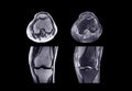 MRI knee joint or Magnetic resonance imaging . Royalty Free Stock Photo