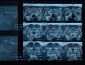 MRI sacroiliac articulation. Study of ankylosing spondyloarthritis patient