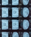 MRI sacroiliac articulation. Study of ankylosing spondyloarthritis patient