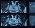 MRI sacroiliac articulation. Study of ankylosing spondyloarthritis patient