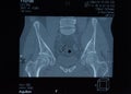 MRI sacroiliac articulation. Study of ankylosing spondyloarthritis patient