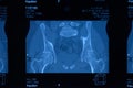 MRI sacroiliac articulation. Study of ankylosing spondyloarthritis patient