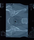 MRI articulation. Study of ankylosing spondyloarthritis patient