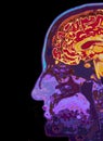 MRI Scan Of Head Showing Brain Royalty Free Stock Photo