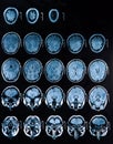 Mri Brain Scan Royalty Free Stock Photo
