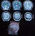 Mri Brain Scan Royalty Free Stock Photo