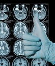 MRI Scan image of a human brain showing all main multiple sclerosis hand in glove thumbs up Royalty Free Stock Photo
