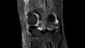 MRI Scan of left knee with ligament rupture