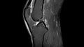 MRI Scan of left knee with ligament rupture