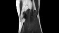 MRI Scan of left knee with ligament rupture