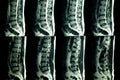 MRI scan of lumbar spines of a patient with chronic back pain