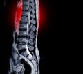 MRI scan of lumbar spines of a patient finding Spinal mass at Lt.side T12-L1 level Severe bulging disc L3-4 causing bilateral L4