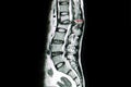 MRI scan of lumbar spines of a patient with kyphosis and back pa