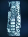 MRI scan of lumbosacral LS spine, coronal view, case of lumbar spondylosis and osteoporotic vertebral compression fractures