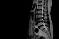 MRI Scan of lumbosacral spine