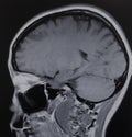 Mri schwannoma brain acoustic neuroma exam