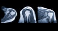 MRI Shoulder joint Axial, Coronal and sagittal plane