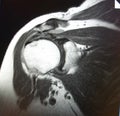 Mri shoulder pathology Royalty Free Stock Photo